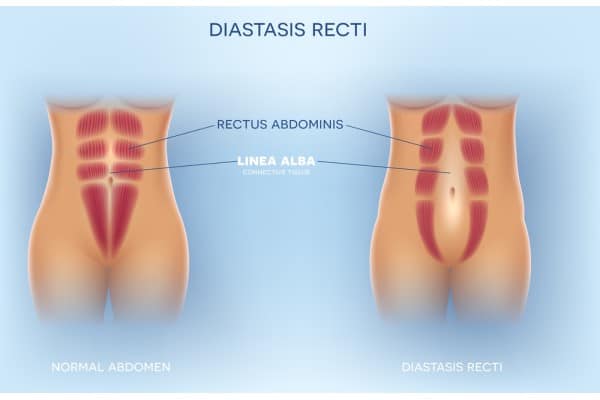 What Non-Surgical Options Are Available for Diastasis Recti Banbury?