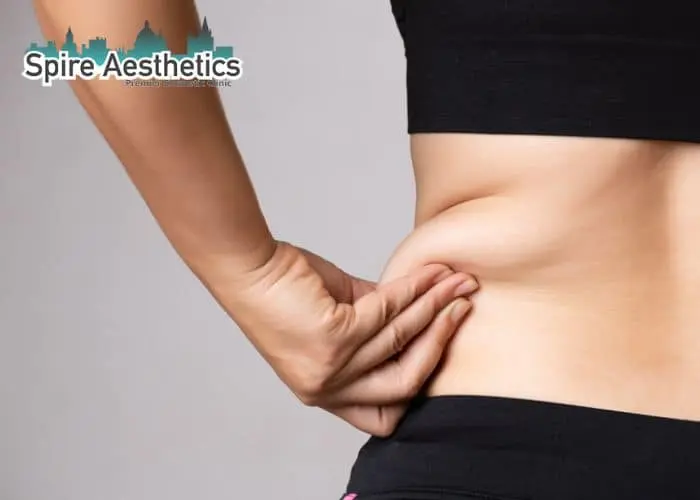 Image of woman pinching fat on their hips Banbury. Fat Freezing treatment