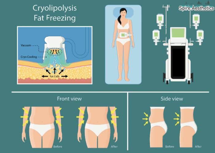 Image of diet and fat freezing combined for best results for Spire Aesthetics Banbury