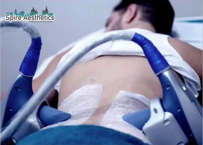 Man having fat freezing treatment done on love handles before a competitions Banbury to create a sculpted look.