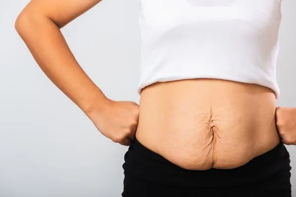 Image of a woman's stomach after weight loss with sagging skin following a gastric band Banbury