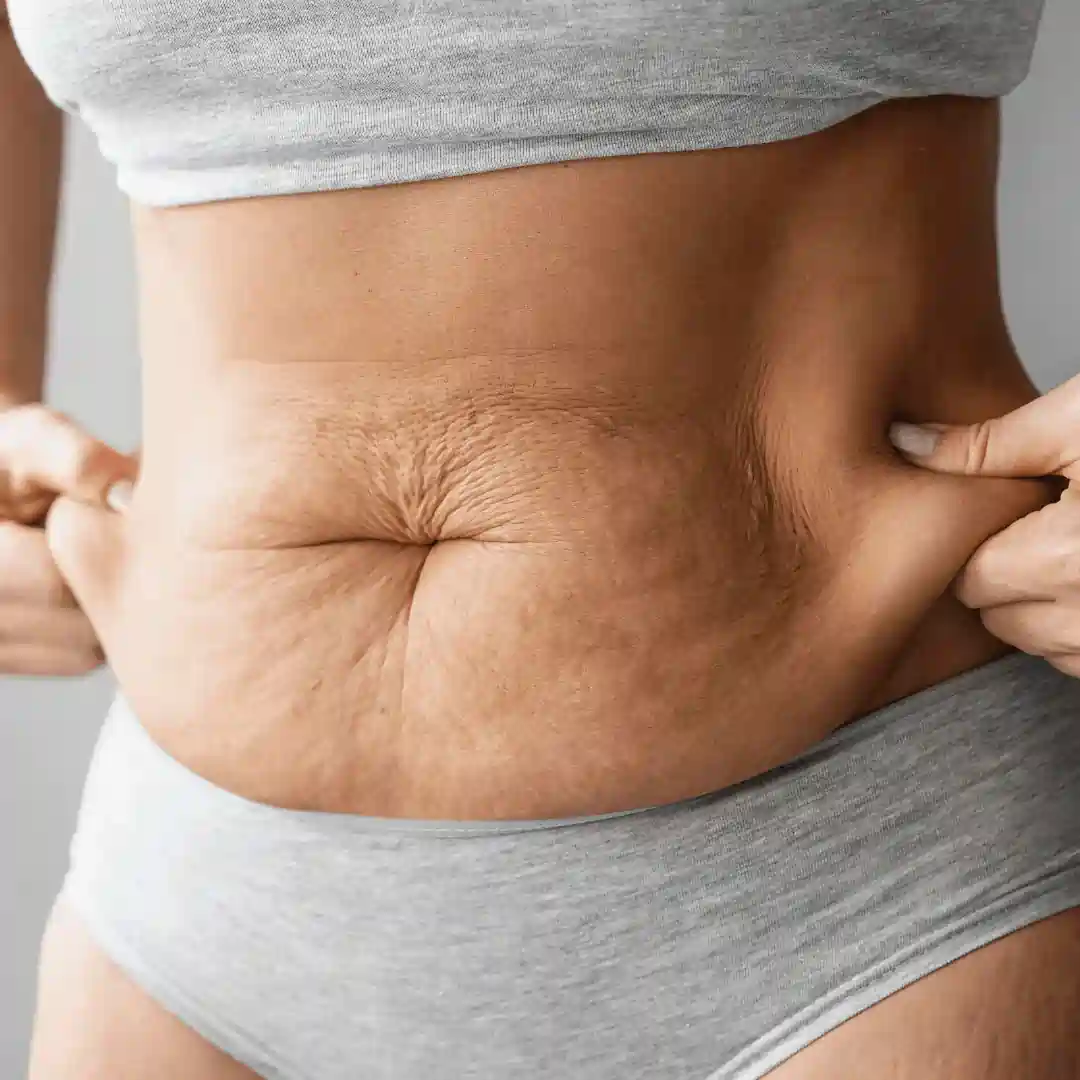 Is It Normal to Have Loose Skin After Pregnancy Banbury?