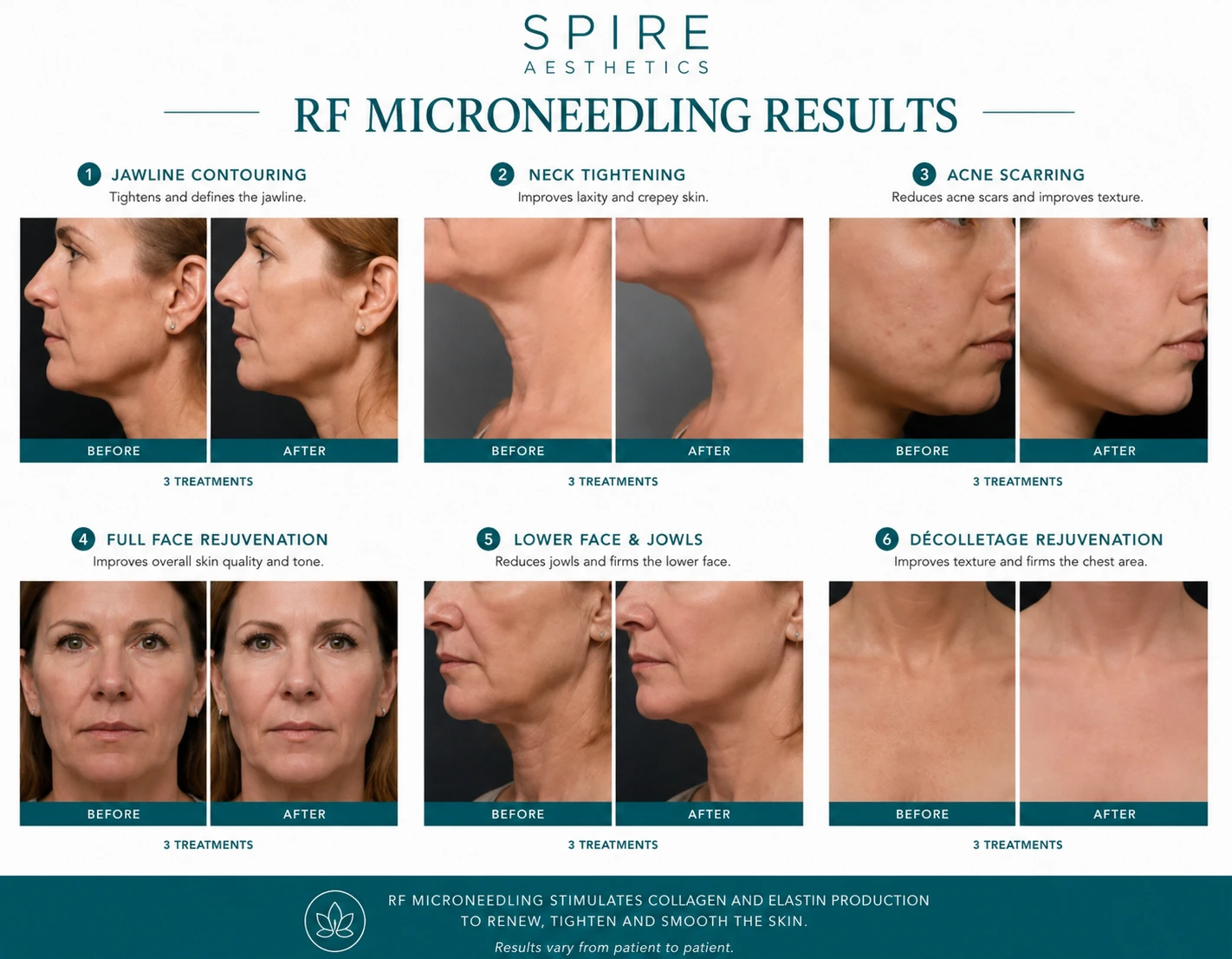RF Microneedling Skin tightening Banbury results