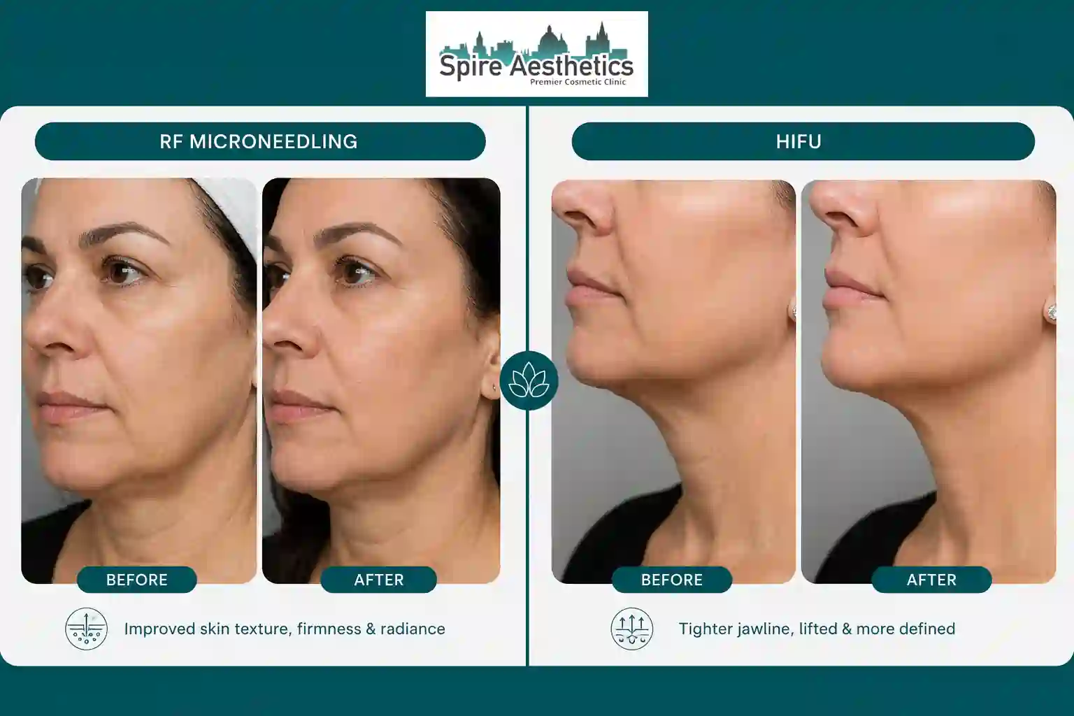 Can RF Microneedling and HIFU Be Combined Banbury?