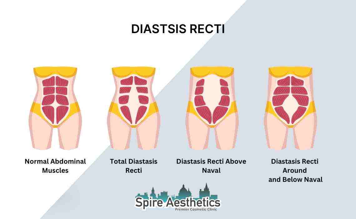Is Non-Surgical Diastasis Recti Treatment Right for You? Common Concerns Answered Banbury